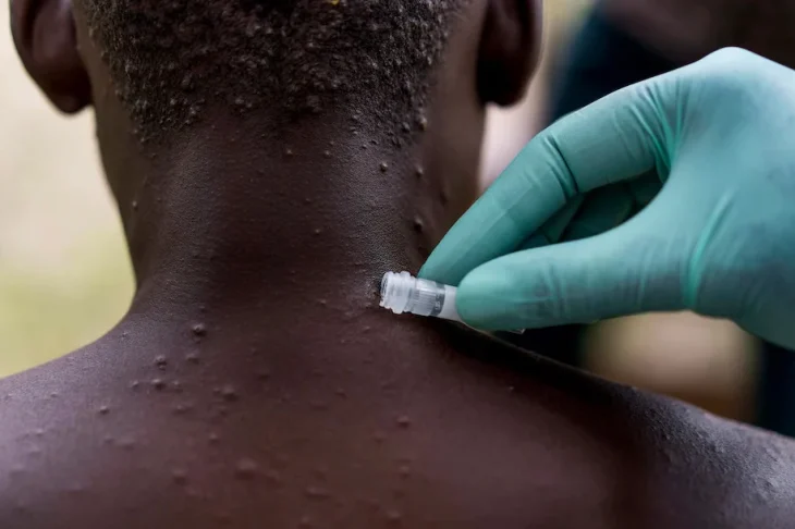 Τι αποφάσισε η Εθνική Επιτροπή Εμβολιασμών για την ευλογία των πιθήκων – Ποιοι θα εμβολιαστούν
