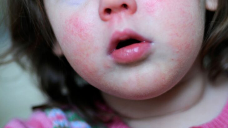 «Προσοχή στα συμπτώματα»: Η συγκλονιστική μαρτυρία ενός πατέρα 4χρονης με στρεπτόκοκκο
